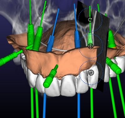 Implantologia Computer Guidata